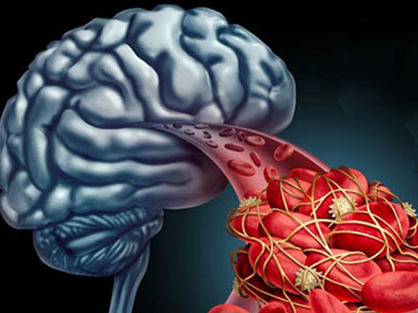Rối loạn tuần hoàn não: Dấu hiệu nhận biết và cách điều trị