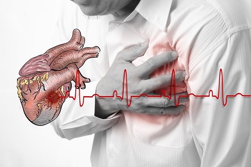 Kết quả hình ảnh cho nhồi máu cơ tim"